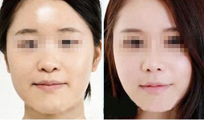激光去除眼袋，持久效果有多久？價格如何，眼周抗衰秘笈大揭示