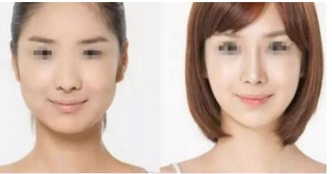 威寧隆胸手術(shù)效果如何？術(shù)后持久無(wú)需擔(dān)心！