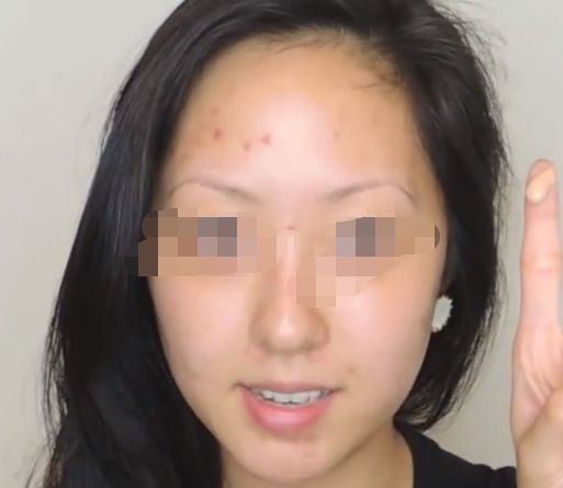 延長透明質(zhì)酸隆鼻效果，多種小竅門讓您保持完美鼻形