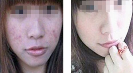 危害程度如何？全方位解析臉部拉皮手術(shù)風(fēng)險與安全