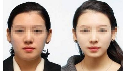 彩光嫩膚：一個(gè)療程要多少次才有效？