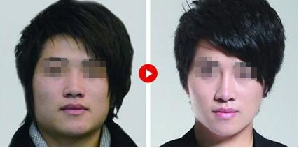 隆鼻修復(fù)，如何科學(xué)達到理想效果？