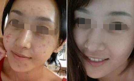 腿部吸脂術(shù)后出現(xiàn)腳腫現(xiàn)象，如何緩解？