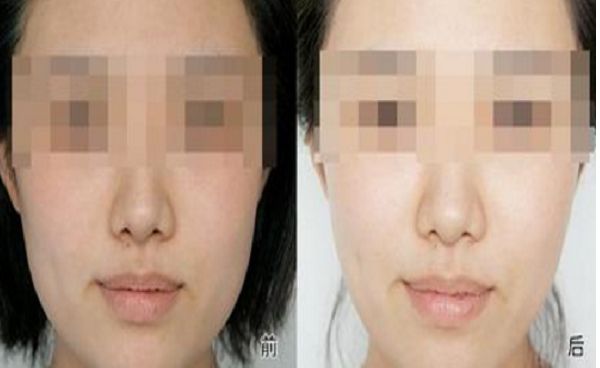 修復(fù)雙眼皮失敗的方法與效果，全面解析助你成功擁有完美雙眼皮