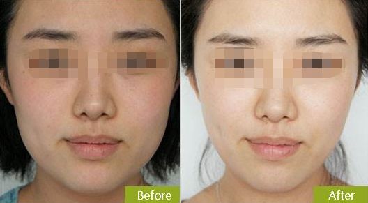 擁有光滑年輕肌膚，無(wú)需手術(shù)的神奇彩光嫩膚方法