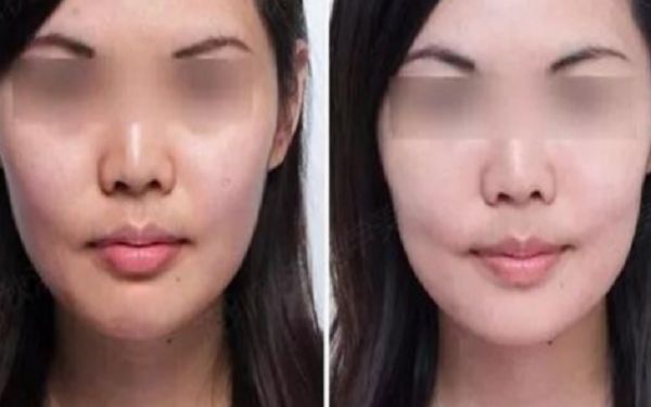35歲采用超聲療程好還是熱瑪吉更好？匿名評(píng)測(cè)揭秘！