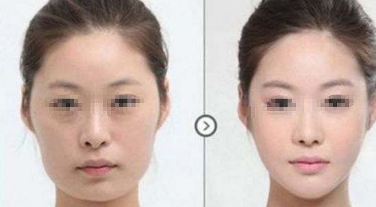 皮膚松弛，如何選擇適合的醫(yī)美項目？熱門方式如熱瑪吉、拉皮等對比解析！