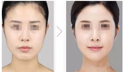 陰道緊縮術(shù)是否痛苦，了解手術(shù)前后的疼痛情況