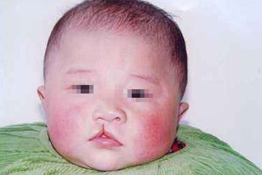 處女膜修復(fù)術(shù)后多久能恢復(fù)正常？