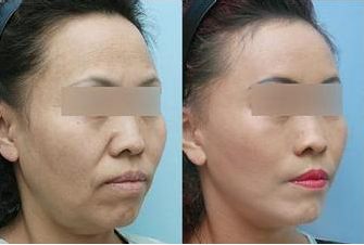施爾美腹部抽脂：手術(shù)后保持效果長(zhǎng)久嗎？