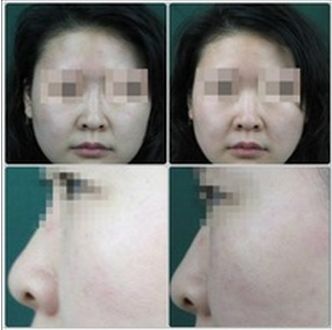處女膜修復(fù)術(shù)最佳時機(jī)推薦