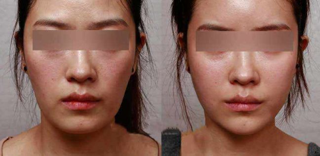 眼袋手術(shù)后效果持續(xù)多久？解析專家分享