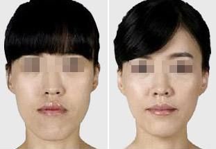 肋骨隆鼻后的面部消腫需要多長時間？消腫小竅門曝光！