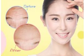 開內(nèi)眼角手術(shù)的疼痛程度如何？解析內(nèi)眼角手術(shù)的全貌