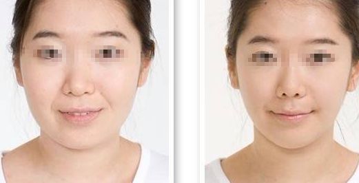 隆鼻手術失敗，修復需謹慎，風險不可忽視
