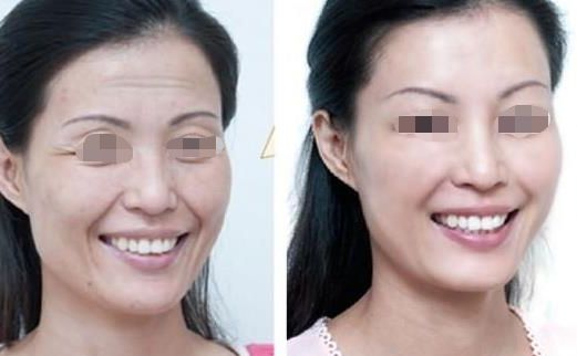 面部吸脂瘦臉效果如何？達到自然效果的關(guān)鍵是什么