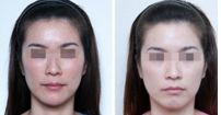 眼袋手術(shù)的維持期有多久？要不要盡早進行手術(shù)？