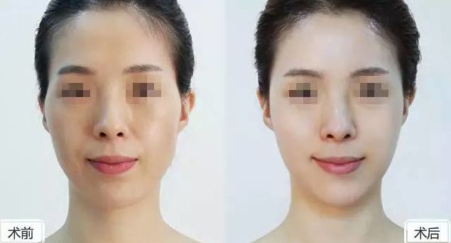 假體隆胸保持持久效果有多久？假體隆胸2個(gè)月后是否固定？