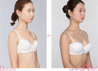 成都耳軟骨復(fù)合隆鼻手術(shù)：專家解析耳軟骨隆鼻效果及價格、術(shù)后護理