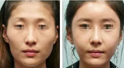 腹部抽脂減肥：注意事項與風險揭秘