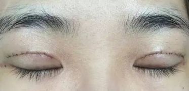 上海王會勇醫(yī)生鼻部整形案例分享：創(chuàng)新技術(shù)助您獲得完美鼻型！