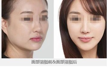 鄭州望京張鵬隆鼻2023年實力及成功案例公開，讓您放心無憂