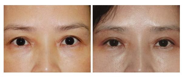 女生變成網(wǎng)紅臉需要多少投入？解析投資成本及效益