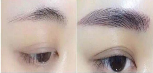 杭城薇琳醫(yī)療美容整形全套服務(wù)及雙眼皮成功案例 杭城薇琳醫(yī)療美容整形全套服務(wù)及雙眼皮成功案例
