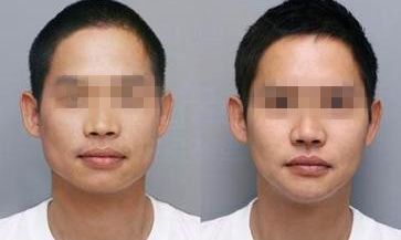 惠州雙眼皮整形醫(yī)院推薦排名:效果認證+口碑價格齊全 惠州雙眼皮整形醫(yī)院推薦排名:效果認證+口碑價格齊全