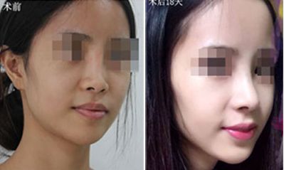 深圳哪家醫(yī)院隆胸效果好？排名前五火熱推薦！