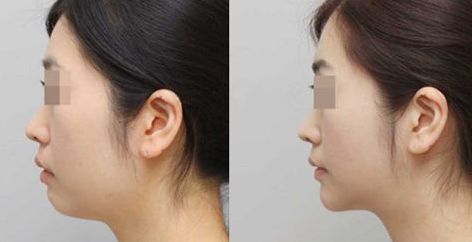 溫州優(yōu)質(zhì)修復(fù)整形醫(yī)院排行榜出爐！成就完美曲線，超高性價比驚艷推薦！