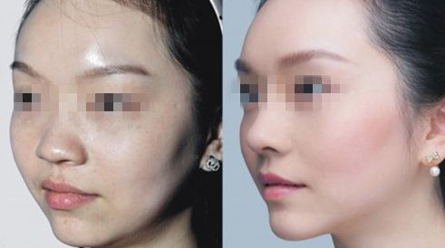 臺(tái)州哪家醫(yī)院治療乳頭矯正效果好？