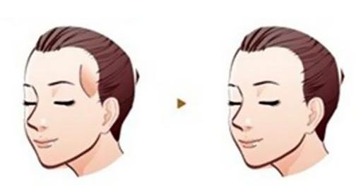 癌癥患者的雙眼皮手術費用分析及成功案例分享 癌癥患者的雙眼皮手術費用分析及成功案例分享