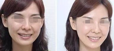 佛山哪家整形醫(yī)院超好的，超皮秒技術(shù)厲害的名單公布