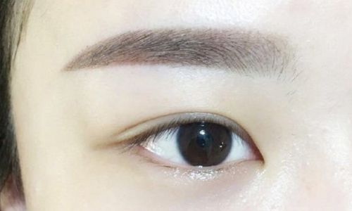 北京郭建玲雙眼皮手術(shù)費(fèi)用是否昂貴？醫(yī)生案例分享全面解析