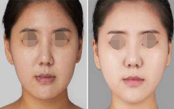西安整形醫(yī)院的磨骨技術有哪些優(yōu)點？