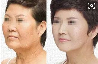 成都去痣名醫(yī)推薦，排行榜前五名有誰？