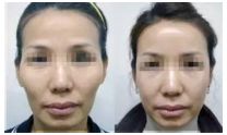 重慶近視眼手術(shù)哪家醫(yī)院好？看看重慶佰視佳眼科醫(yī)院怎么樣