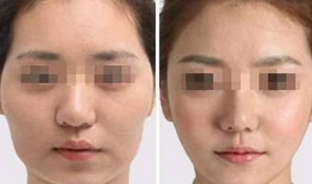 揭秘北京東方和諧脂肪填充真容，真實(shí)案例展示精湛技藝！