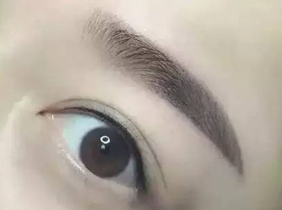 蘇州圣愛醫(yī)院整形科：90天變化揭示，雙眼皮驚喜盡顯！