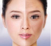 劉志剛醫(yī)生雙眼皮手術(shù)效果怎么樣？