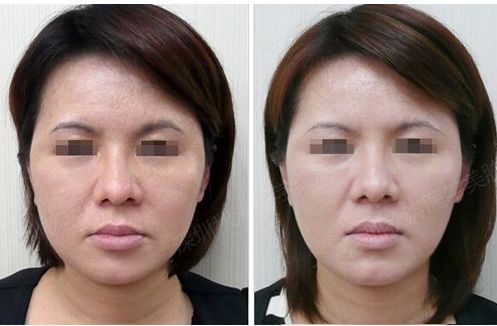 吉大一院皮膚科光子嫩膚效果怎么樣？專家團(tuán)隊(duì)解析祛斑案例