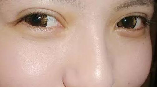 沈陽元辰眼袋整形手術效果如何？推薦醫(yī)生和術后評價分享！