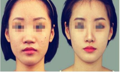 贛州哪家醫(yī)院的鼻部整形好？