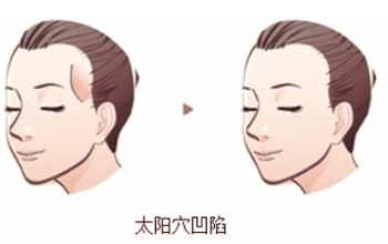 蘇州美貝爾與美萊：隆鼻比較！價(jià)格與特色對(duì)比！