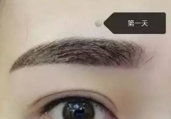 馮斌自體脂肪豐胸效果如何？案例分享給您