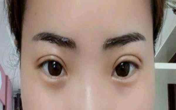 丁硯江填充脂肪的效果如何？為什么該方法備受推崇？