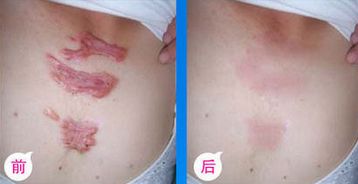 九院脂肪填充，醫(yī)生技術(shù)高超，詳細(xì)價(jià)格表揭曉