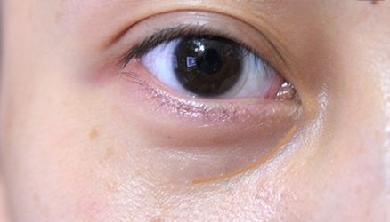 【重慶】銅雀臺雙眼皮醫(yī)生技術(shù)對比，伍森林、王杰醫(yī)、梁海彬誰更厲害？