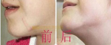 長沙最佳吸脂手術(shù)醫(yī)院排名，雅美、華韓華美、鵬愛等值得借鑒的評價